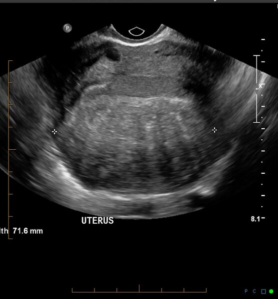 File:Adenomyosis uterus with hematometra (Radiopaedia 45779-51705 Transverse 1).jpg