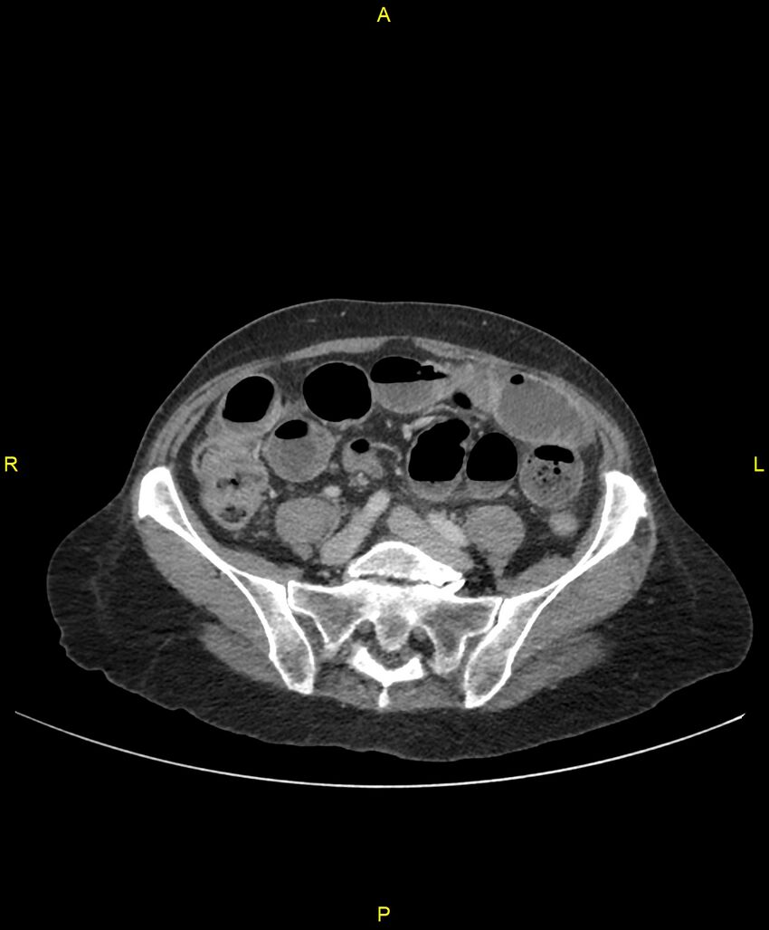 Adhesional small bowel obstruction (Radiopaedia 85402-101024 Axial C+ portal venous phase 196).jpg