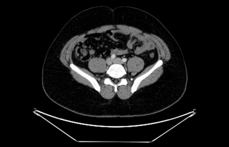 File:Adrenocortical carcinoma (Radiopaedia 80134-93438 Axial C+ portal venous phase 90).jpg
