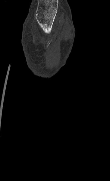 File:Advanced osteomyelitis due to open metatarsal fracture (Radiopaedia 83891-99095 Coronal bone window 20).jpg