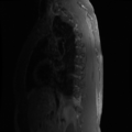 Aggressive vertebral hemangioma (Radiopaedia 39937-42404 B 17).png