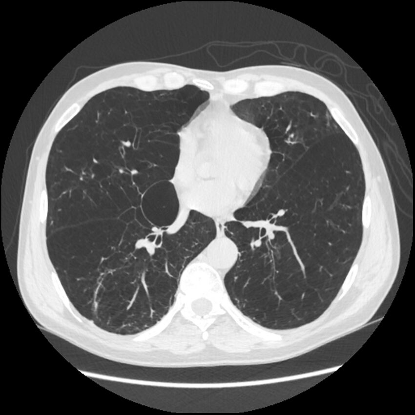 Alpha-1-antitrypsin deficiency (Radiopaedia 40993-43722 Axial lung window 148).jpg