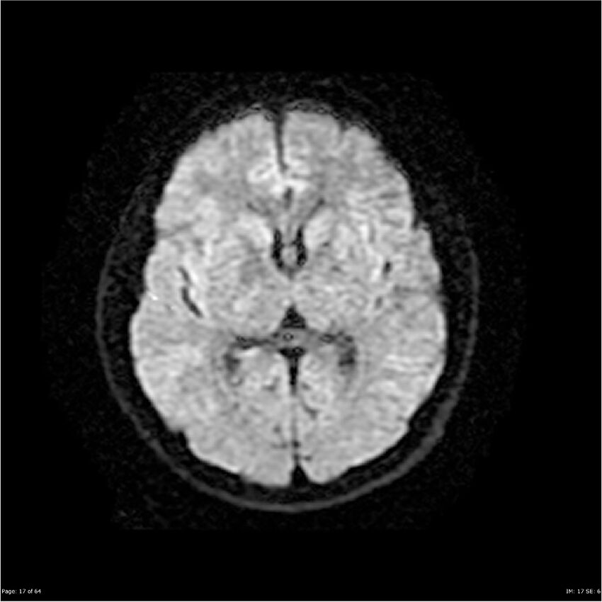 Amnestic syndrome secondary to hypoxic brain injury (Radiopaedia 24743-25004 DWI 17).jpg