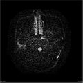 Amnestic syndrome secondary to hypoxic brain injury (Radiopaedia 24743-25004 DWI 3).jpg