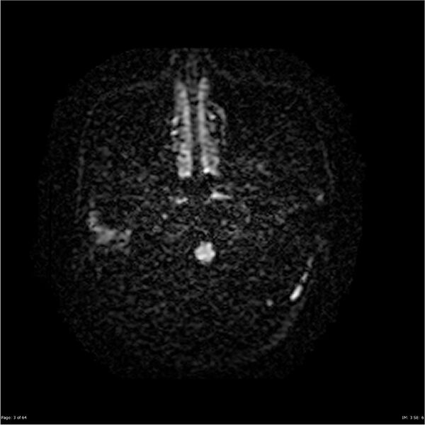 File:Amnestic syndrome secondary to hypoxic brain injury (Radiopaedia 24743-25004 DWI 3).jpg