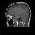 Amnestic syndrome secondary to hypoxic brain injury (Radiopaedia 24743-25004 T1 5).jpg