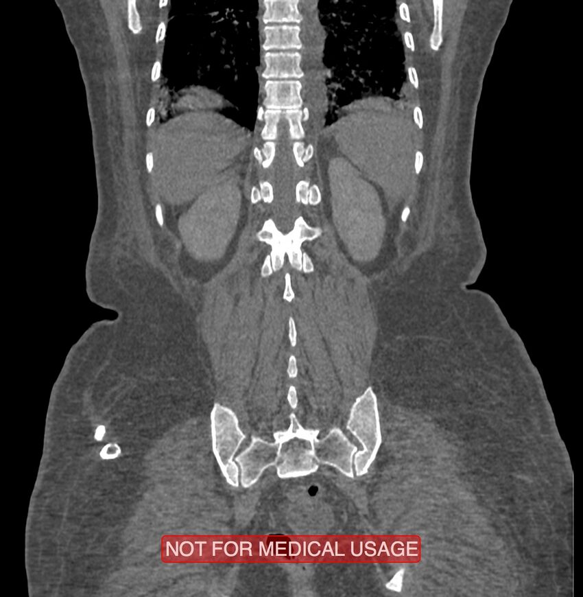 Amoebic enterocolitis with liver abscess (Radiopaedia 35100-36609 B 169).jpg