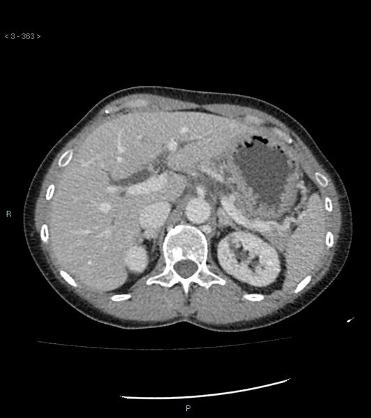 File:Ampulla of Vater metastasis (Radiopaedia 27820-28069 A 1).jpg