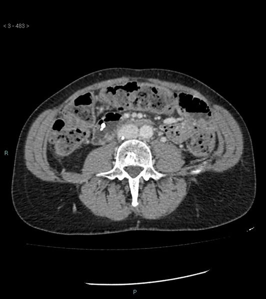 File:Ampulla of Vater metastasis (Radiopaedia 27820-28069 A 121).jpg
