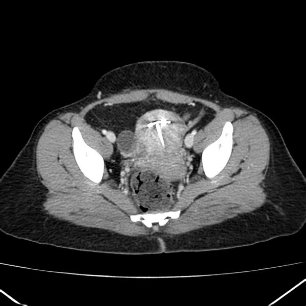 File:Ampullary tumor (Radiopaedia 22787-22816 C 60).jpg