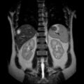 Ampullary tumor (Radiopaedia 27294-27479 Coronal T2 19).jpg