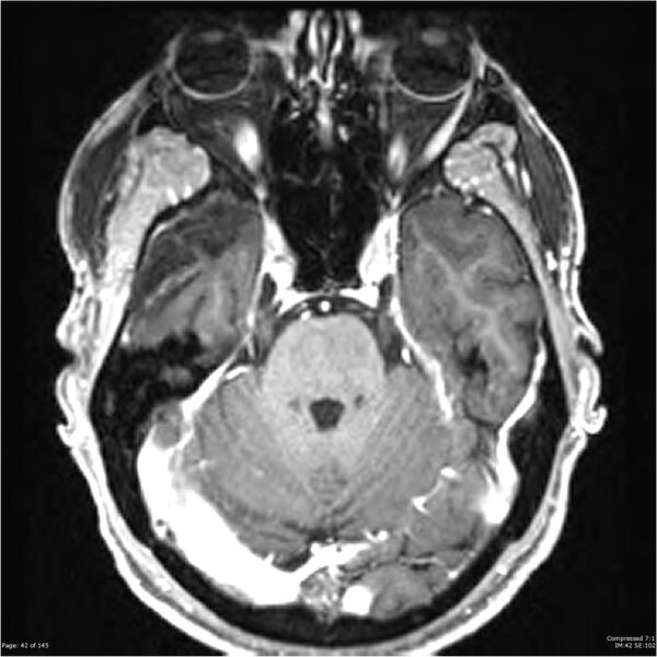 File:Anaplastic meningioma with recurrence (Radiopaedia 34452-35788 Axial T1 C+ 42).jpg