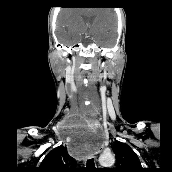 File:Anaplastic thyroid carcinoma (Radiopaedia 79087-92034 A 67).jpg