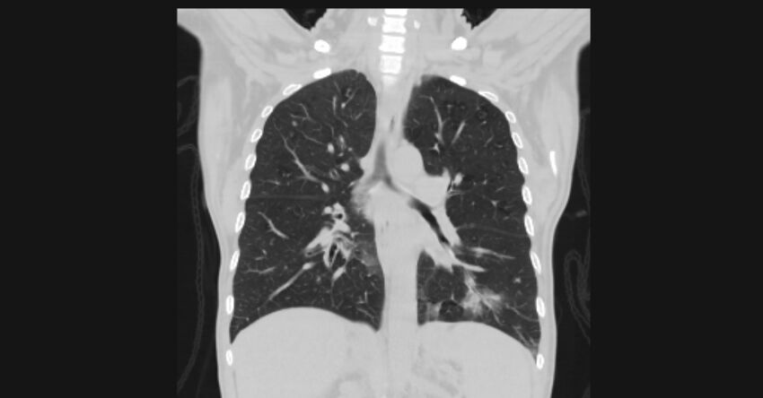 Angioinvasive aspergellosis (Radiopaedia 66995-76315 Coronal lung window 37).jpg