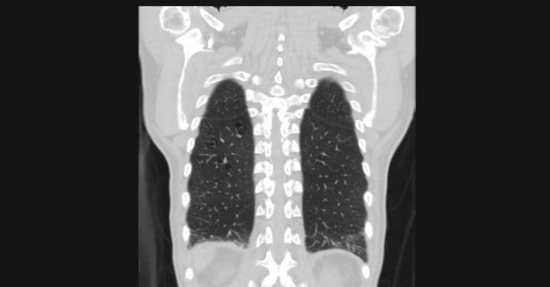 File:Angioinvasive aspergellosis (Radiopaedia 66995-76315 Coronal lung window 53).jpg