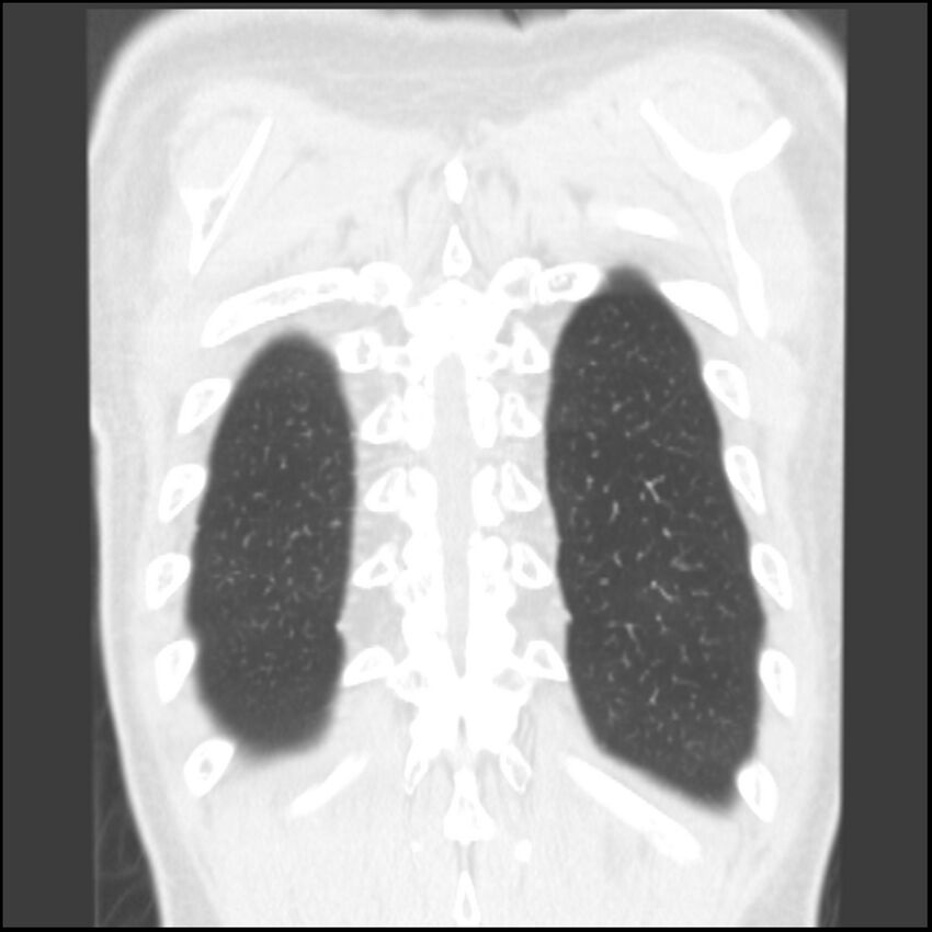 Angioinvasive aspergillosis (Radiopaedia 43957-47466 Coronal lung window 8).jpg