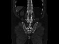 Ankylosing spondylitis (Radiopaedia 44609-48357 Coronal bone window 79).jpg