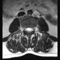 Ankylosing spondylitis with zygapophyseal arthritis (Radiopaedia 38433-40516 Axial T2 12).jpg