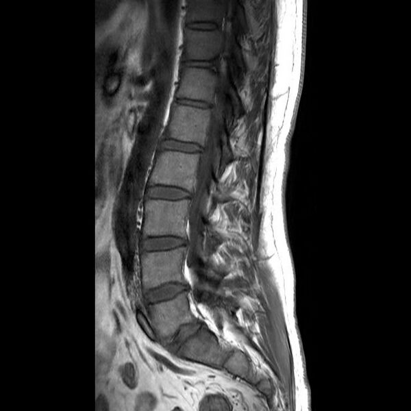 File:Ankylosing spondylitis with zygapophyseal arthritis (Radiopaedia 38433-40516 Sagittal T1 4).jpg
