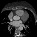 Anomalous origin of left circumflex artery from right coronary sinus (Radiopaedia 72563-83117 B 51).jpg
