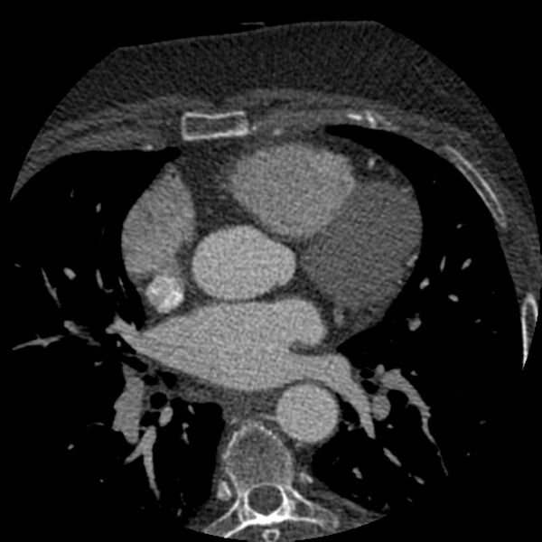 File:Anomalous origin of left circumflex artery from right coronary sinus (Radiopaedia 72563-83117 B 51).jpg