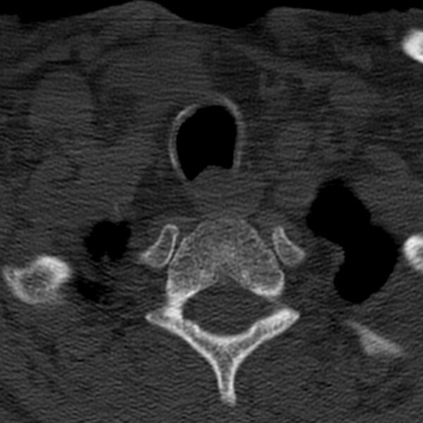 File:Anterior cervical postdiscectomy arthrodesis (Radiopaedia 32678-33646 Axial bone window 68).jpg