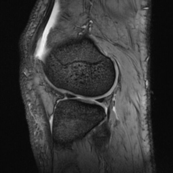 File:Anterior cruciate ligament tear - ramp lesion (Radiopaedia 71883-82322 Sagittal T2 fat sat 7).jpg