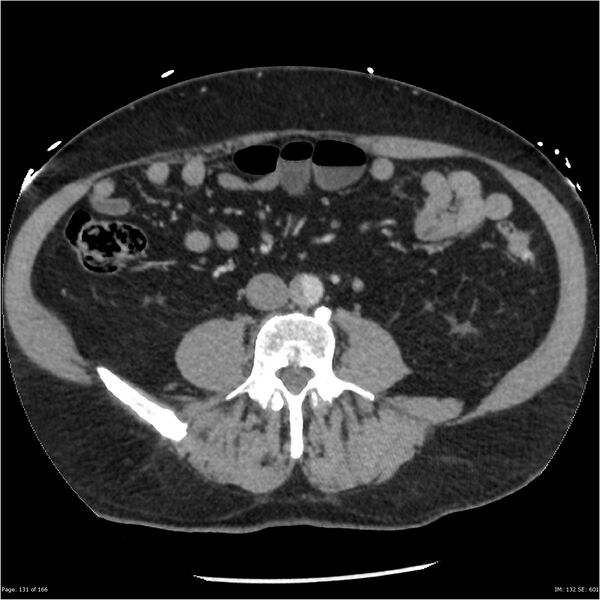 File:Aortic dissection- Stanford A (Radiopaedia 37759-39664 A 122).jpg