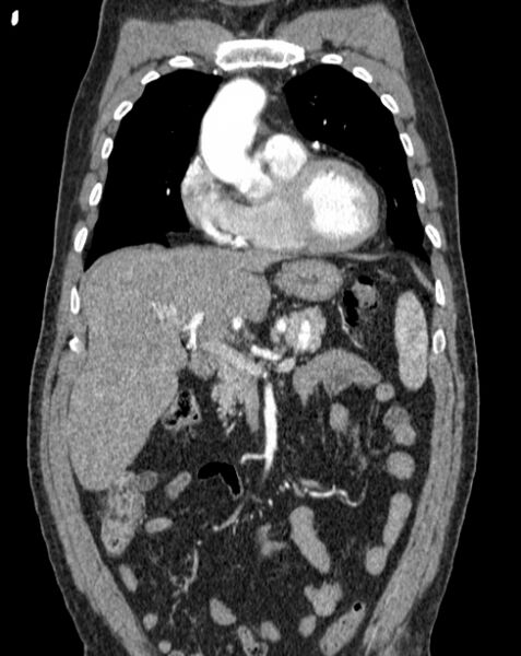 File:Aortic dissection (Radiopaedia 44411-48061 A 6).jpg