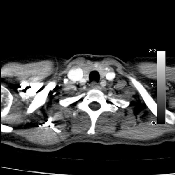 File:Aortic dissection - Stanford type A (Radiopaedia 29247-29659 A 6).jpg