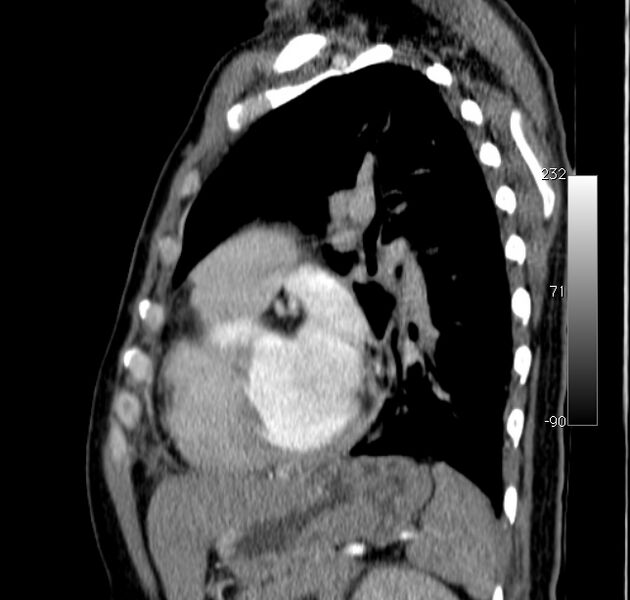 File:Aortic dissection - Stanford type A (Radiopaedia 29247-29659 C 15).jpg