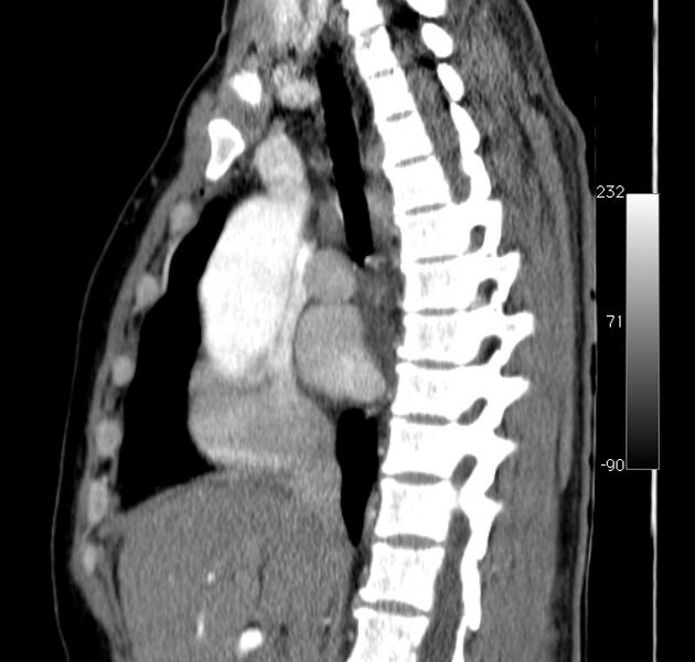 File:Aortic dissection - Stanford type A (Radiopaedia 29247-29659 C 32).jpg