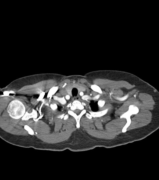 File:Aortic dissection with renal ischemia (Radiopaedia 76573-88338 A 2).jpg