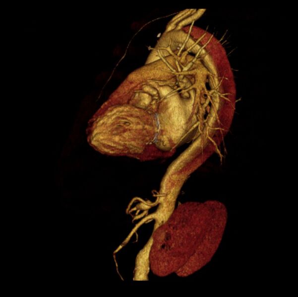 File:Aortic dissection with rupture into pericardium (Radiopaedia 12384-12647 D 27).jpg