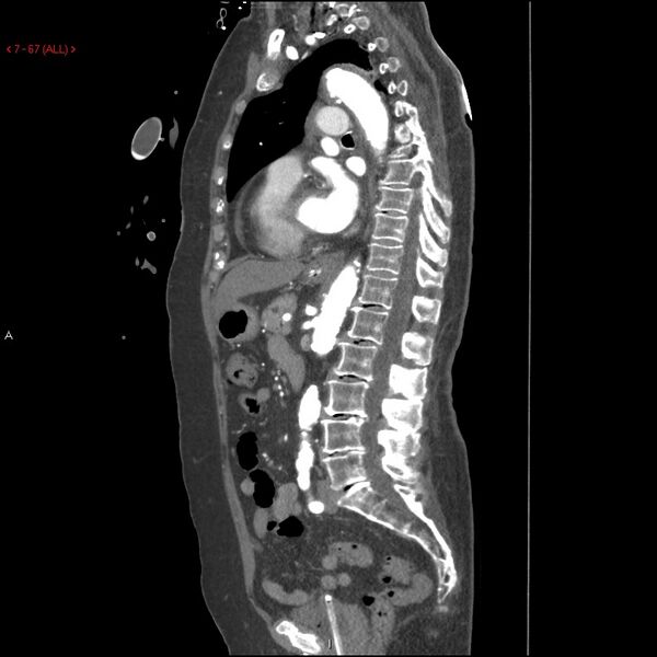 File:Aortic intramural hematoma (Radiopaedia 27746-28001 C 36).jpg