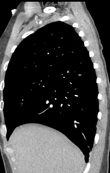 File:Aortic valve non-coronary cusp thrombus (Radiopaedia 55661-62189 C+ arterial phase 55).png