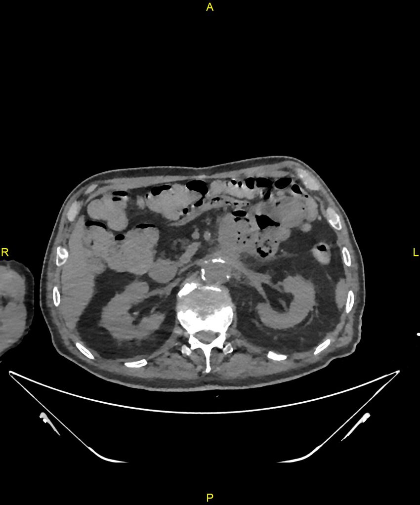 Aortoenteric fistula (Radiopaedia 84308-99603 Axial non-contrast 113).jpg