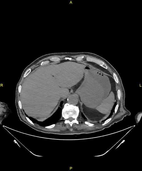 File:Aortoenteric fistula (Radiopaedia 84308-99603 Axial non-contrast 44).jpg