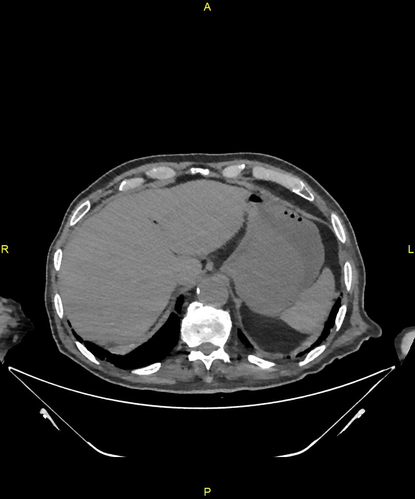 Aortoenteric fistula (Radiopaedia 84308-99603 Axial non-contrast 44).jpg