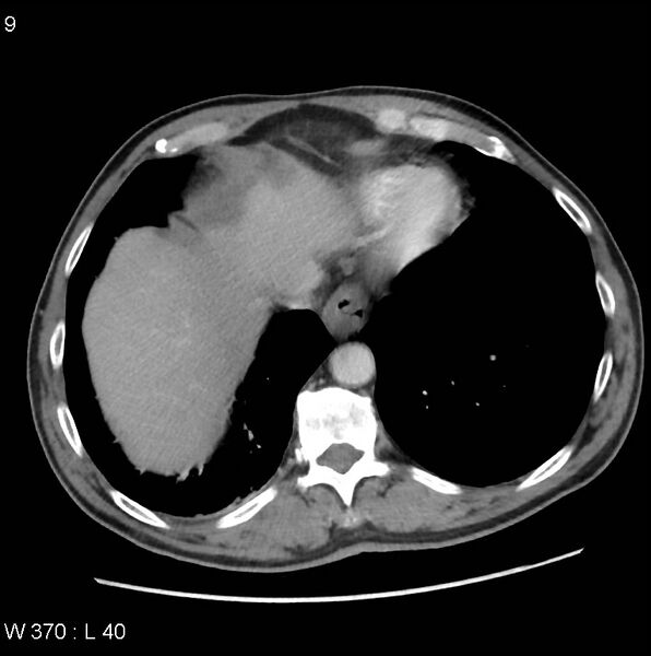 File:Appendicitis (Radiopaedia 27446-27642 A 2).jpg