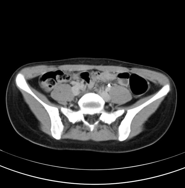 File:Appendicitis and incidental bicornuate uterus (Radiopaedia 22833-22853 Axial C+ delayed 26).jpg