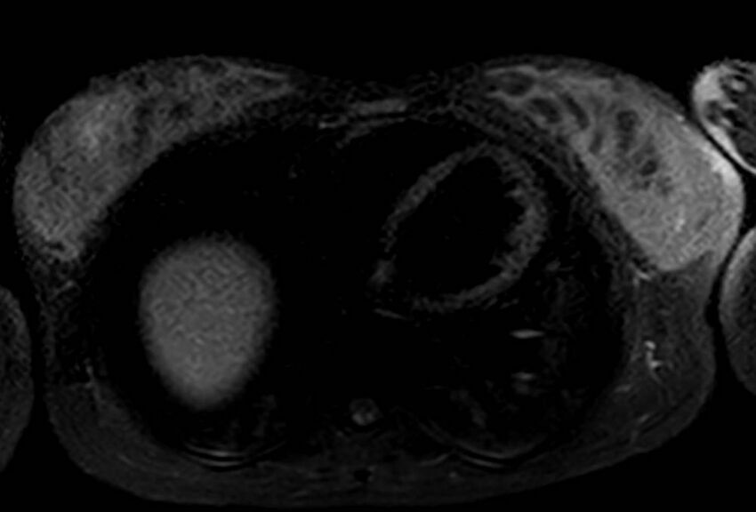 Appendicitis in gravida (MRI) (Radiopaedia 89433-106395 Axial T2 SPAIR 2).jpg