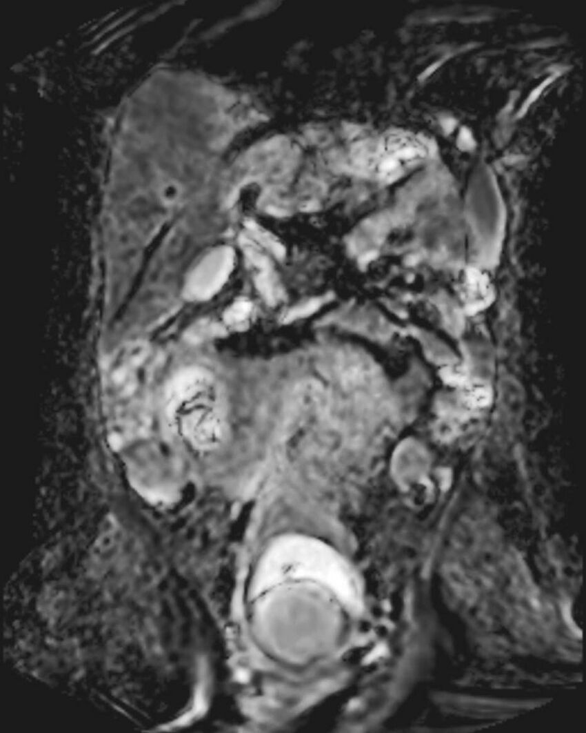 Appendicitis in gravida (MRI) (Radiopaedia 89433-106395 Coronal ADC 29).jpg