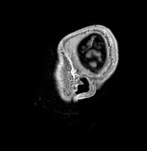 File:Arachnoid cyst- extremely large (Radiopaedia 68741-78451 Sagittal T1 C+ 4).jpg