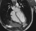 Arrhythmogenic right ventricular cardiomyopathy (Radiopaedia 39806-42237 D 73).jpg