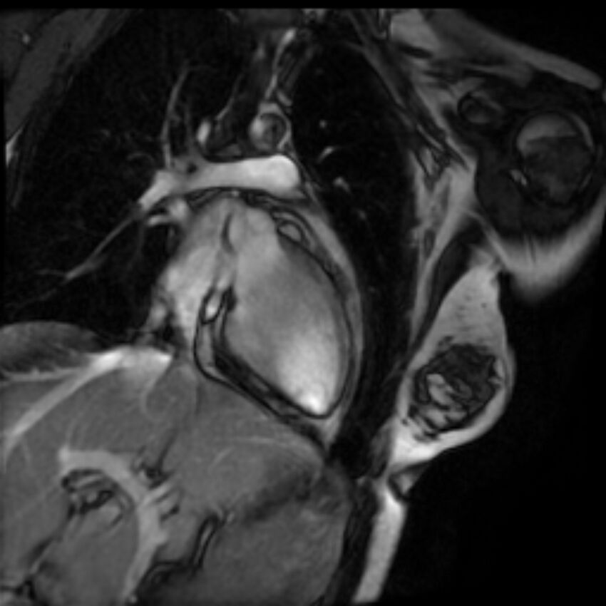 Arrhythmogenic right ventricular cardiomyopathy (Radiopaedia 87505-103850 2ch (LV) Cine SSFP 13).jpg