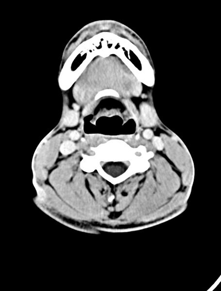 File:Arrow injury to the face (Radiopaedia 73267-84011 Axial C+ delayed 11).jpg