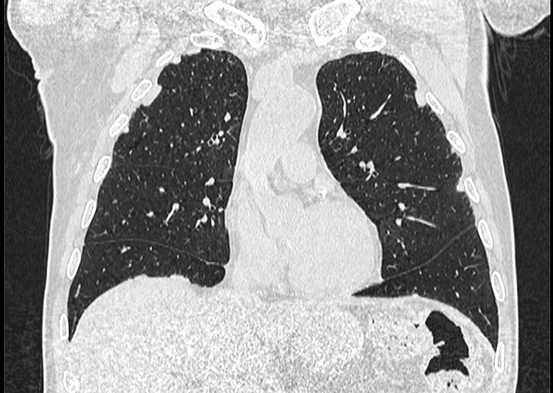 File:Asbestos pleural placques (Radiopaedia 57905-64872 Coronal lung window 109).jpg