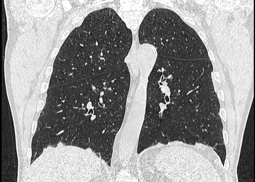 Asbestos pleural placques (Radiopaedia 57905-64872 Coronal lung window 186).jpg