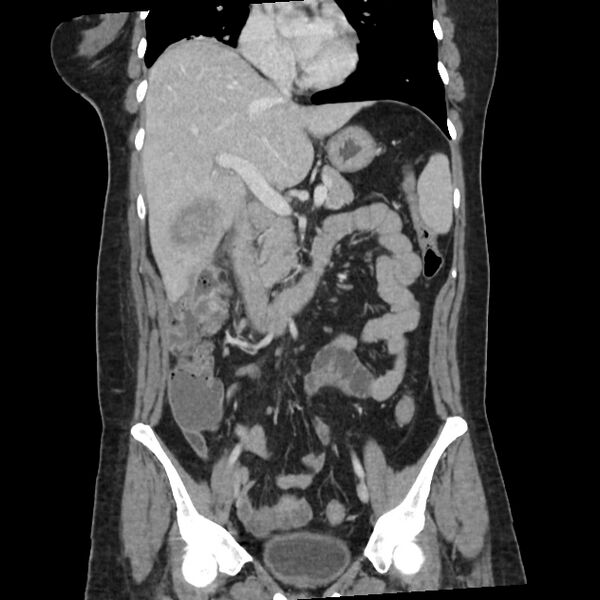 File:Ascending retrocecal appendicitis with liver abscesses (Radiopaedia 60066-67615 C 23).jpg